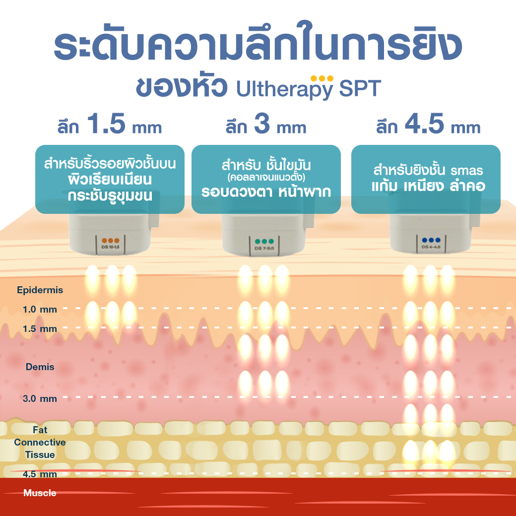 ยกกระชับ Ultherapy SPT ยกผิว ยกหน้า กระชับผิวหน้า ลดริ้วรอย หน้าเรียว ลดเหนียง รีวิวยกกระชับ