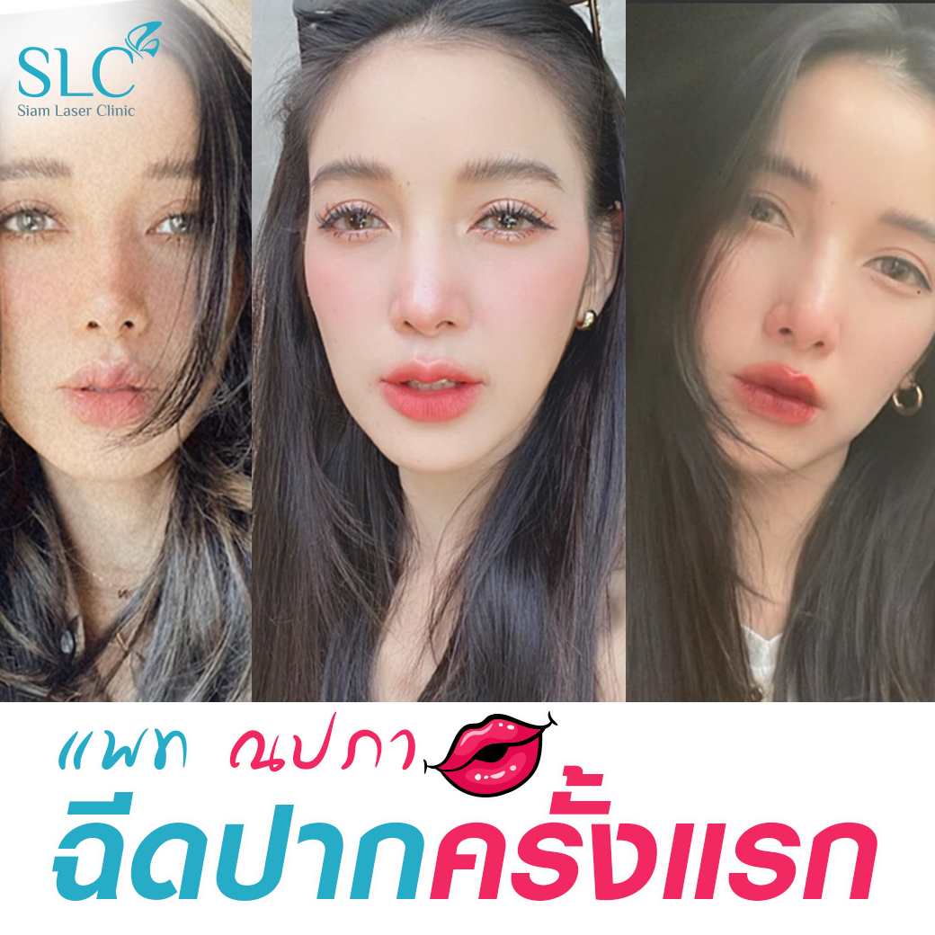 ฉีดปาก สายฝอ_Filler_Lip