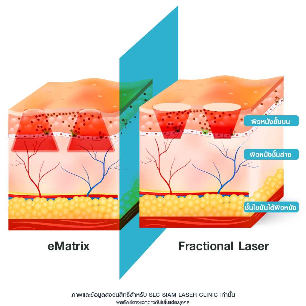 Fraxel_Ematrix_รีวิวรักษาสิว_รักษาหลุมสิว_หลุมสิว_แพ้แมสก์