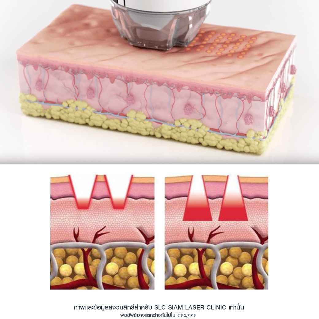 Fraxel_Ematrix_รีวิวรักษาสิว_รักษาหลุมสิว_หลุมสิว_แพ้แมสก์