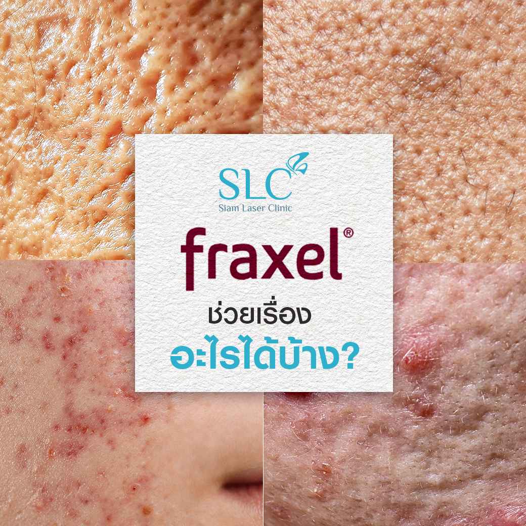 Fraxel_Ematrix_รีวิวรักษาสิว_รักษาหลุมสิว_หลุมสิว_แพ้แมสก์