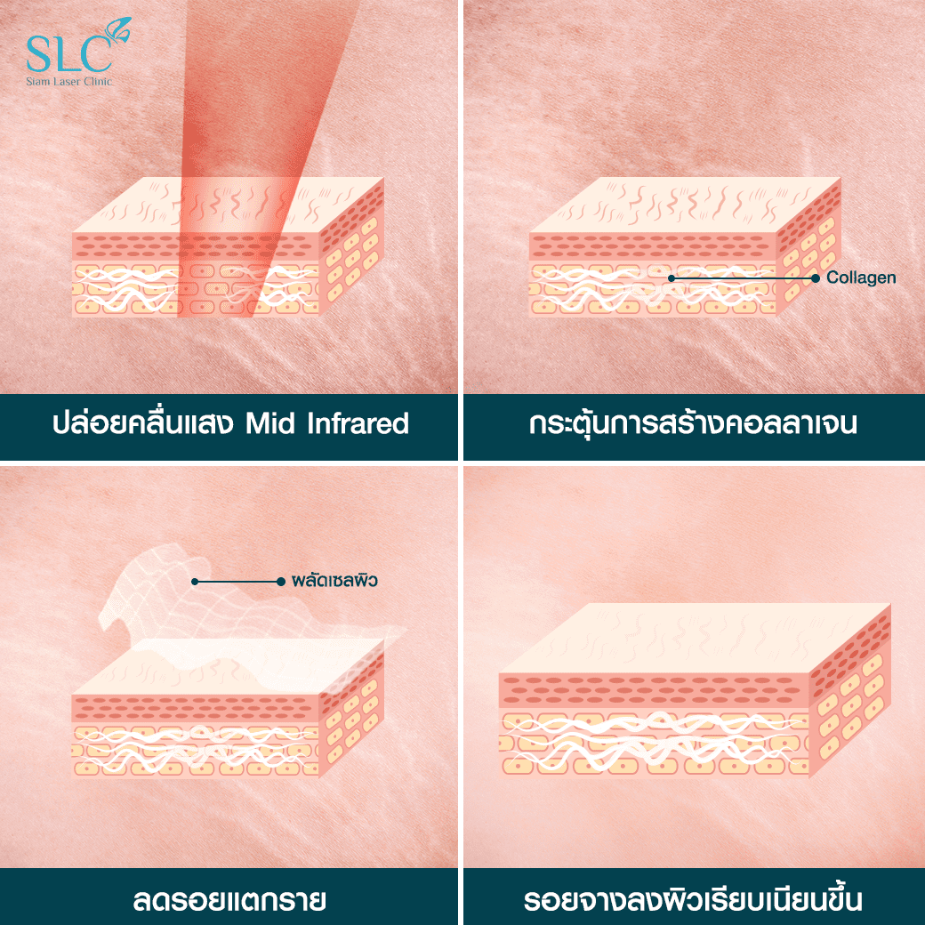 Fraxel_eyeta_ลบรอยแตกลาย_ก้นลาย_ผิวแตก