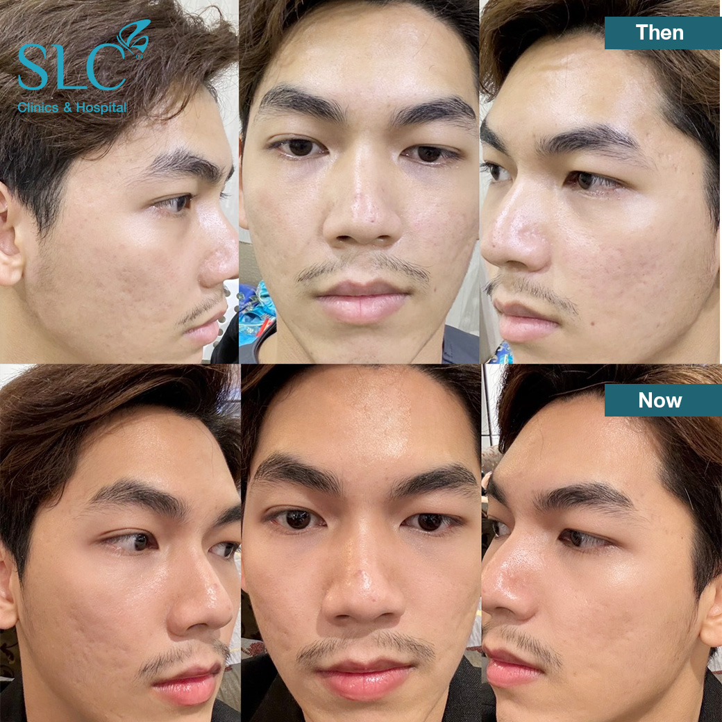 Dewy Skin Booster,Dewy Skin Boosterคือ,โบ,โบงานผิว,โบท็อกซ์,botox,หน้ามันแก้ยังไง,แก้รูขุมขนกว้าง,ผิวเนียนทำยังไง