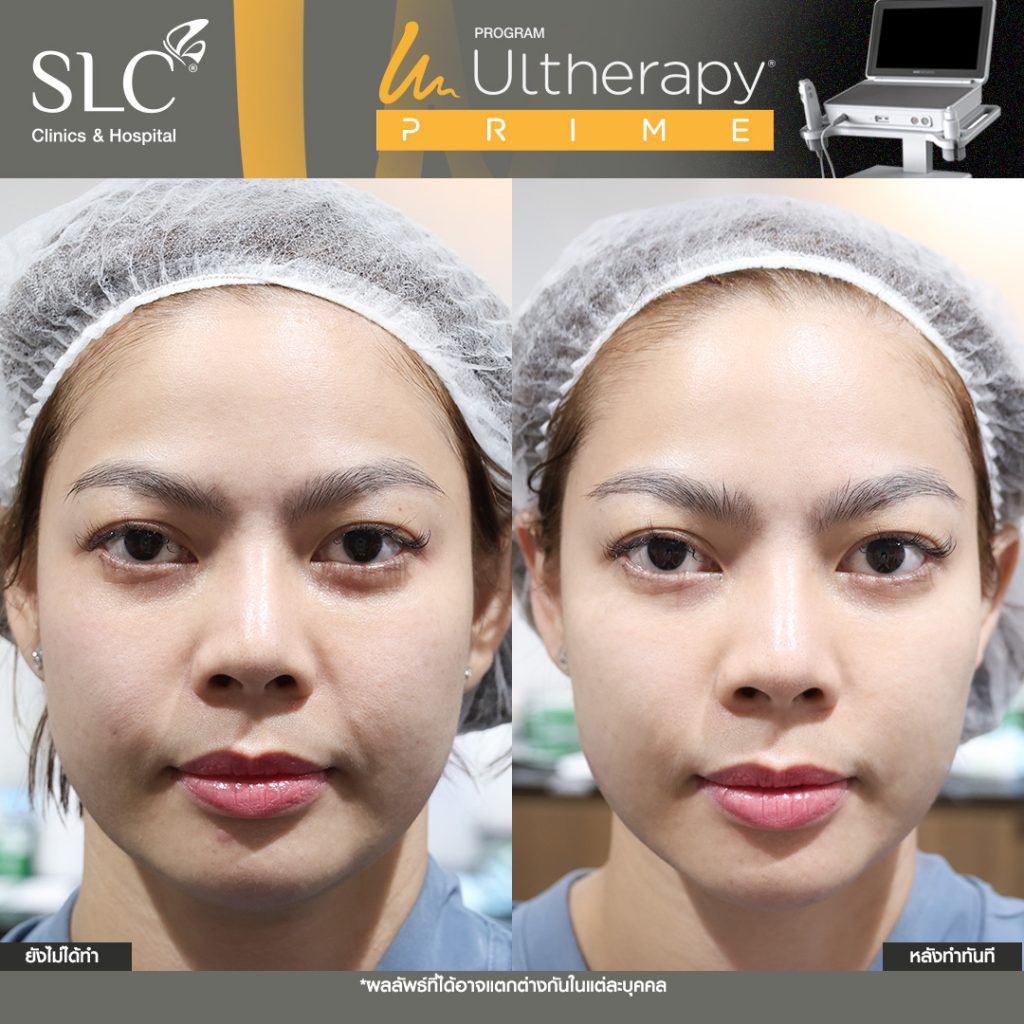 ก่อนและหลังทำ Ulthera Prime ทันที ราย 1