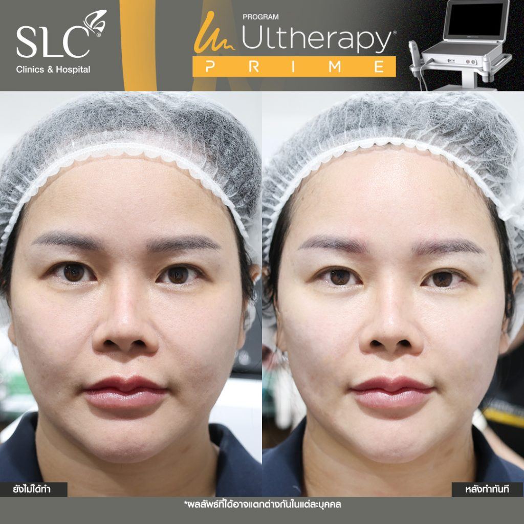 ก่อนและหลังทำ Ulthera Prime ทันที ราย 2
