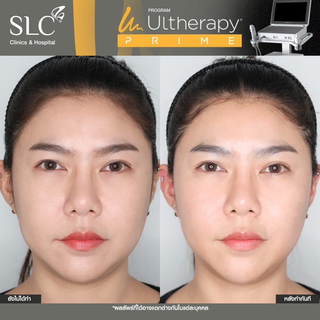 ก่อนและหลังทำ Ulthera Prime ทันที ราย 3