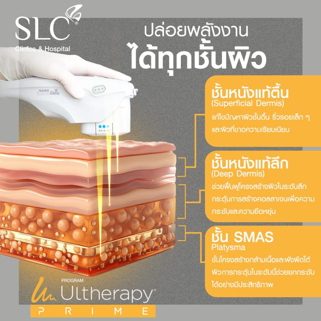 Ulthera Prime ปล่อยพลังงานได้ถึงชั้น SMAS