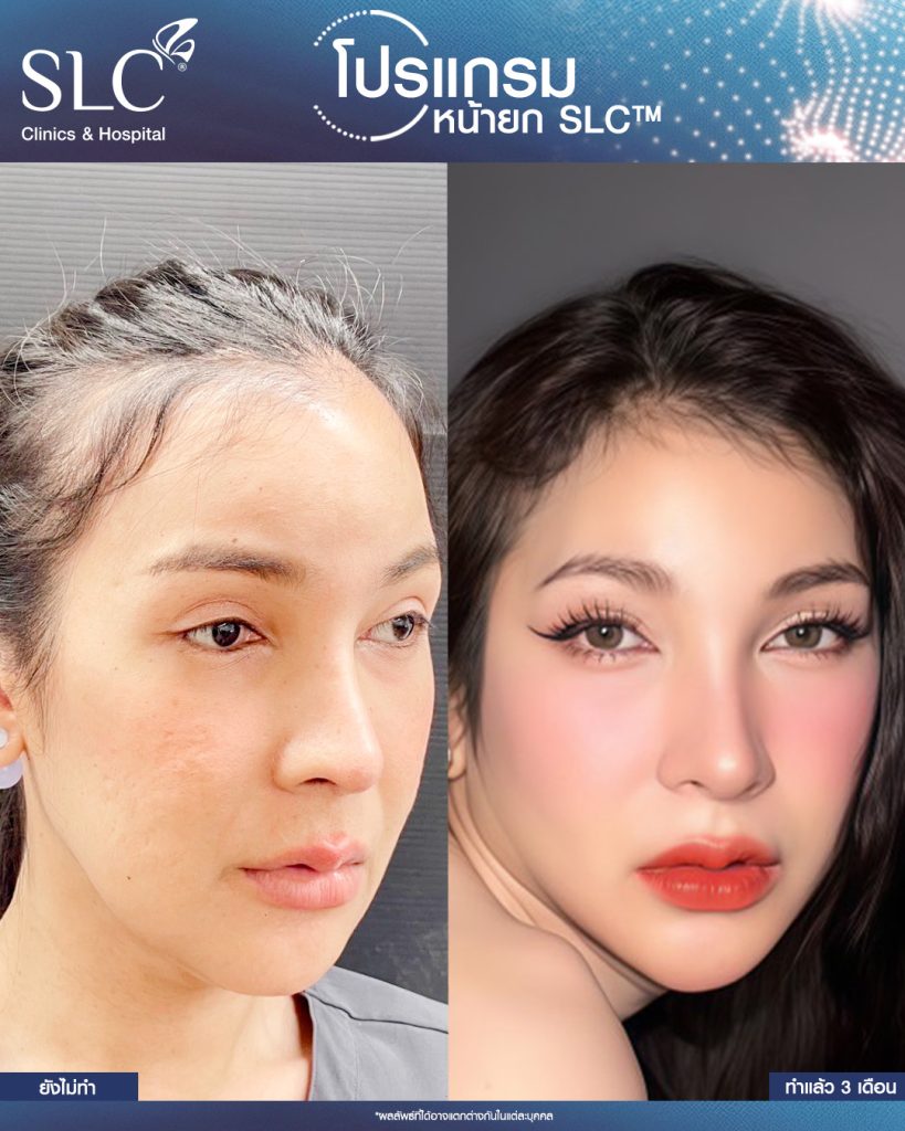 HArmonyCa Filler Program (HACa) คืออะไร? ช่วยยกหน้าและกระตุ้นคอลลาเจน ...