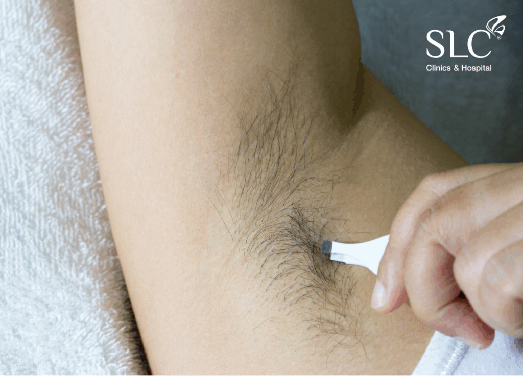 เนียนนานไม่เป็นตอ, ขนคุด, โปรแกรม SLC Laser Hair Removal, เลเซอร์กำจัดขน, ผิวหมองคล้ำ
