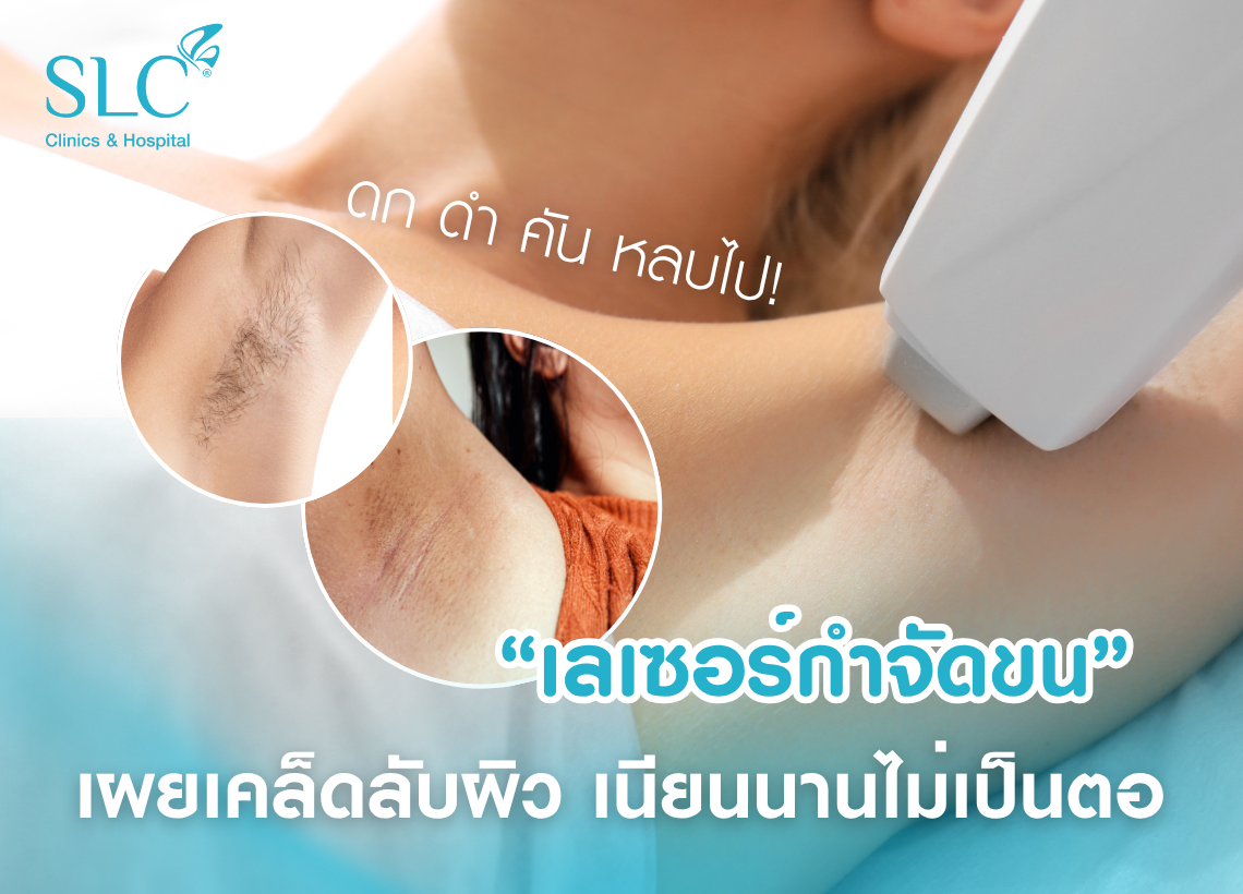 เนียนนานไม่เป็นตอ, ขนคุด, โปรแกรม SLC Laser Hair Removal, เลเซอร์กำจัดขน, ผิวหมองคล้ำ