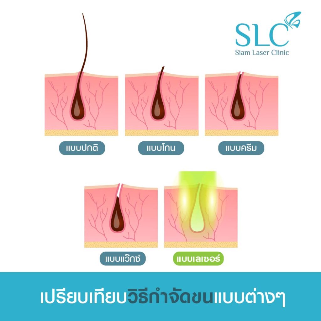 อินโฟกราฟิกเปรียบเทียบวิธีกำจัดขนแบบต่าง ๆ แบบถอน แบบโกน แบบครีม แบบแว็กซ์ และแบบเลเซอร์