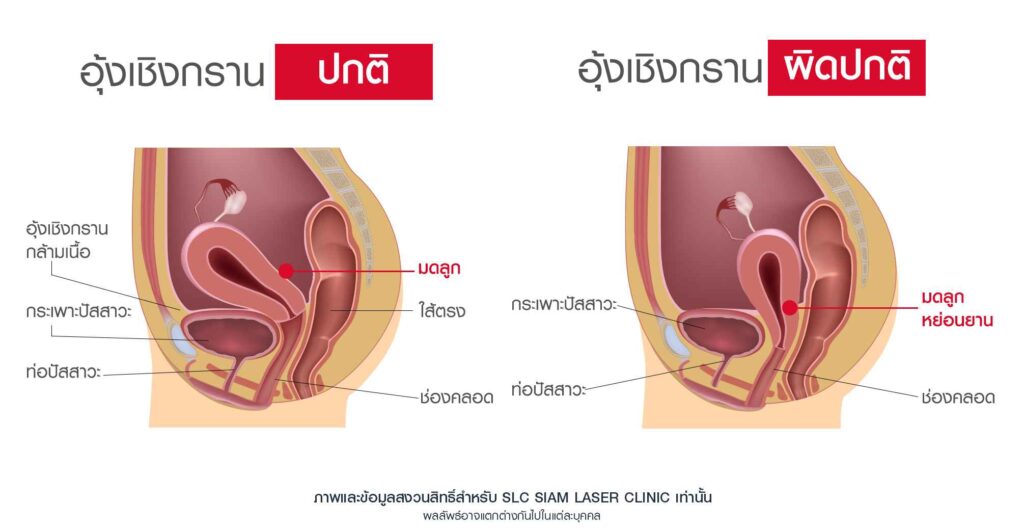 ทำไมขำแล้วฉี่เล็ด