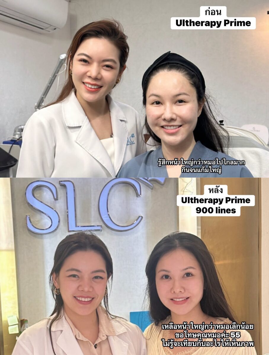 ก่อนและหลังทำ Ultherapy Prime 900 lines ที่ SLC Clinic