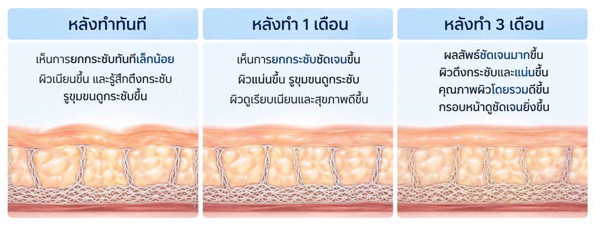 ไทม์ไลน์ผลลัพธ์หลังทำ Ulthera: หลังทำทันที หลังทำ 1 เดือน และ 3 เดือน