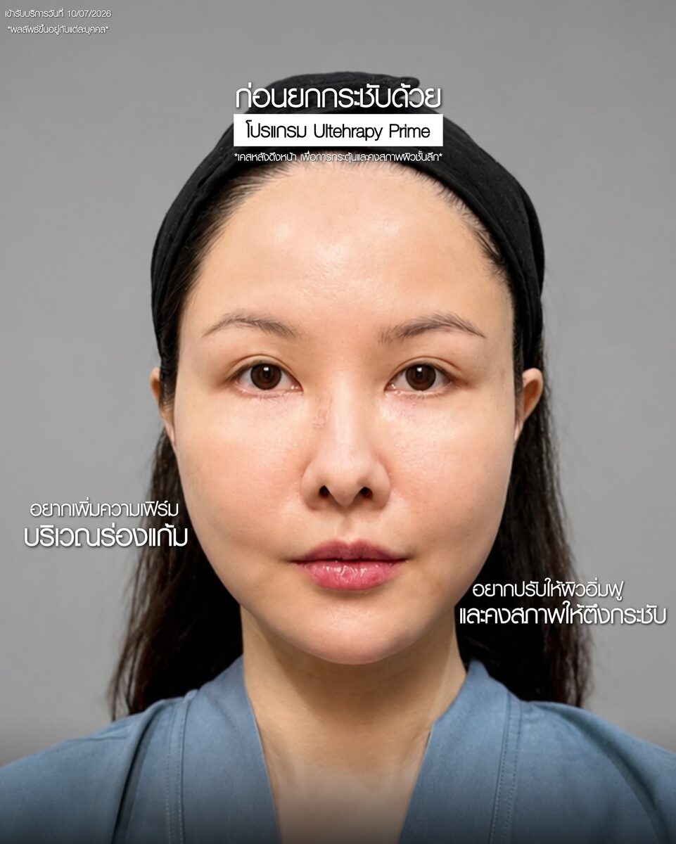 ก่อนทำ Ultherapy Prime เคสต้องการเพิ่มความเฟิร์มบริเวณร่องแก้ม