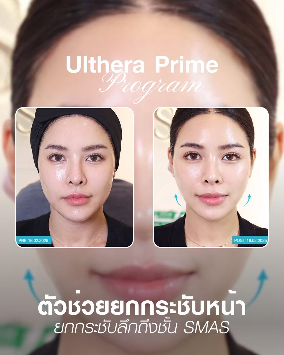 รีวิวก่อน-หลังทำ Ultherapy Prime ยกกระชับกรอบหน้าและแก้ม